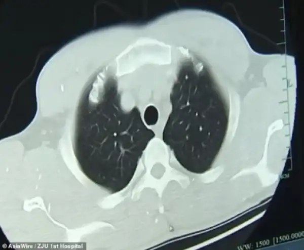 Over 700 Tapeworms Found Inside Man